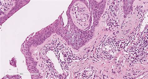 Pathology Outlines Squamous Papilloma Conjunctiva