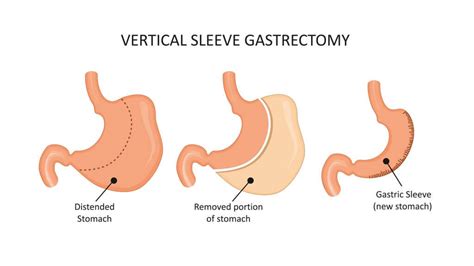 Gastric Sleeve How It Works Is It Worth It Coh Clinic