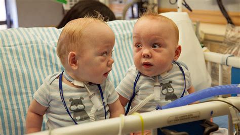 Formerly Conjoined Twins Separated In August To Be Released