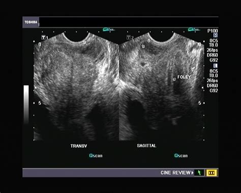 Ultrasound And Color Doppler Videos Prostate Transrectal Ultrasound Quiz