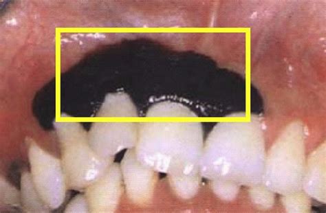 牙齦發黑是怎麼回事？小心這四點，是其中一種都要注意了！ 每日頭條