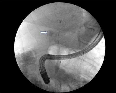 Ercp Image 4 Days After The Biopsy Shows Contrast Extravasation From A