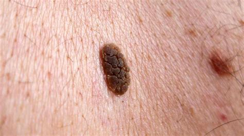 Treatment For Seborrhoeic Keratoses Everything Skin Clinic