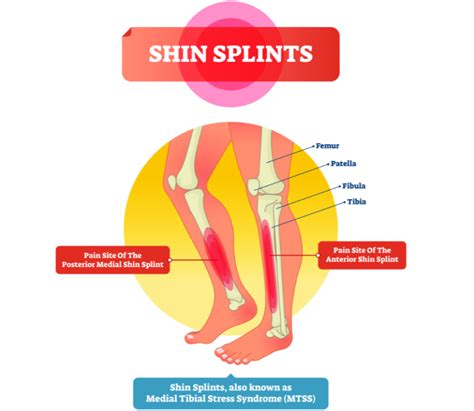 All About Shin Splints South Dublin Podiatry