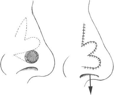 The Bilobed Flap For Reconstruction Of Distal Nasal Defect In Asians