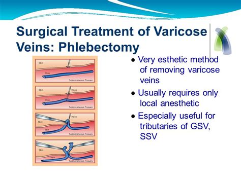Microphlebectomy Surgery The Vein And Laser Centre