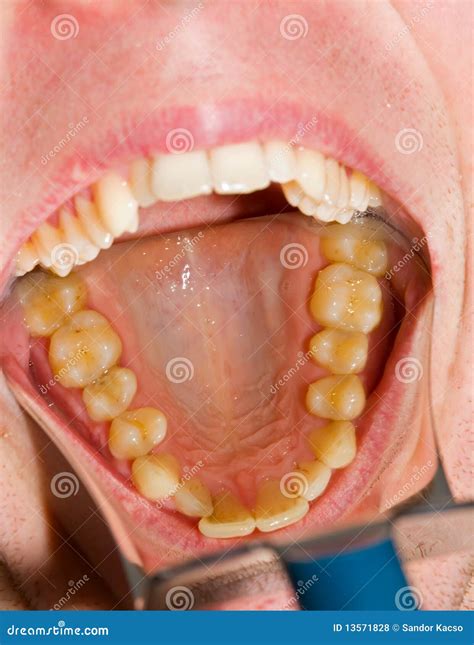 Dental Photography Stock Photo Image Of Obturator Dentistry 13571828
