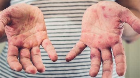 Gold Coast Major Measles Alert For Seven Suburbs Herald Sun