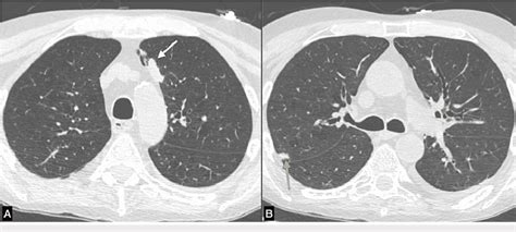 Axial Ct Image A Shows A Lobulated Solid Pulmonary Nodule In The