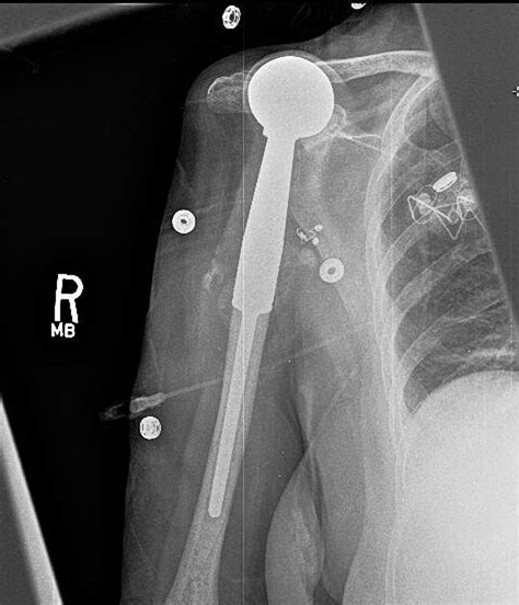 Reverse Total Shoulder Arthroplasty Provides Stability And Better