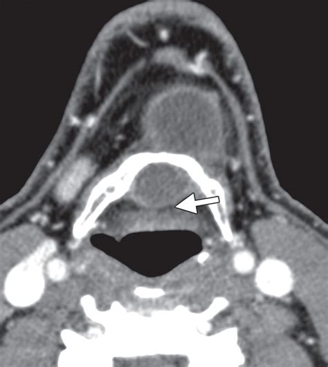 Imaging Of Ectopic Thyroid Tissue And Thyroglossal Duct Cysts