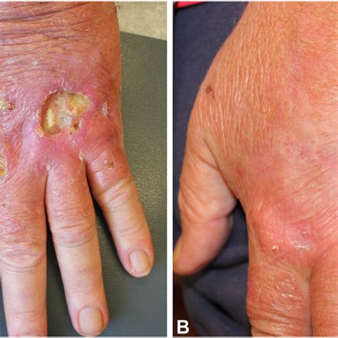 Pyoderma Gangrenosum In Patient 2 At A Baseline With Severely Painful