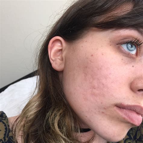 Dermovate For Acne Scars