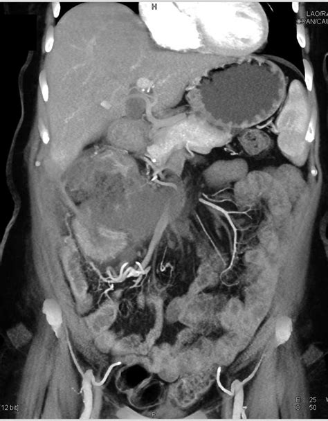 Perforated Gallbladder With A Large Abscess Gastrointestinal Case