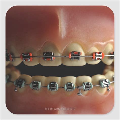 What Is The Best Color For Braces Quiz Warehouse Of Ideas