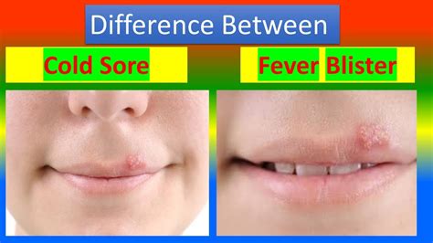 Difference Between Cold Sore And Fever Blister Youtube