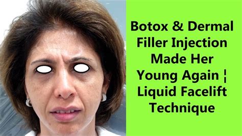 Botox And Dermal Filler Injections To Look Younger Liquid Facelift