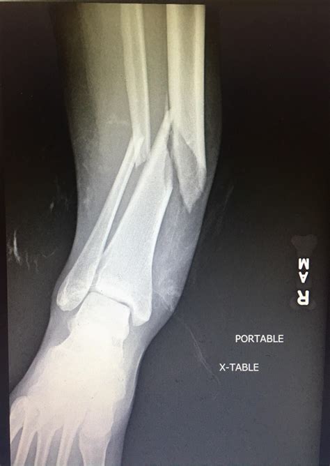 My Recent Tibia And Fibula Fracture Rmedizzy