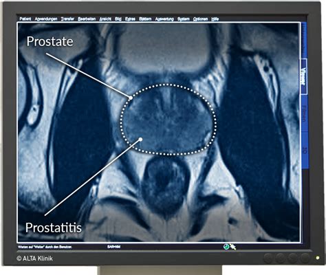 Multiparametric Mri Of The Prostate Alta Klinik