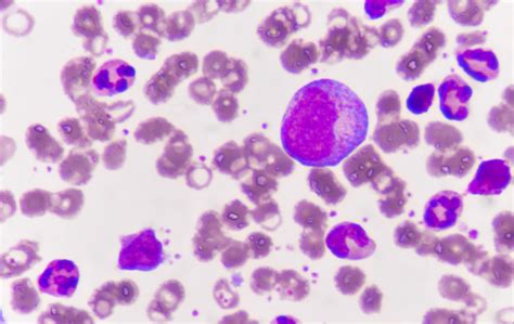 Chronic Lymphocytic Leukaemia Onmedica