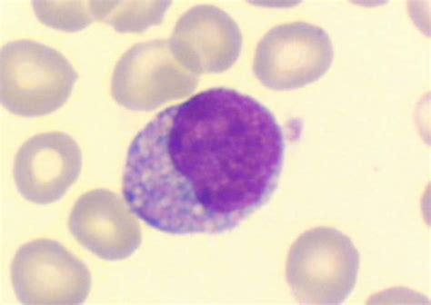 A Lymphocyte With Many Vacuole Like Inclusions The Cytoplasm Is