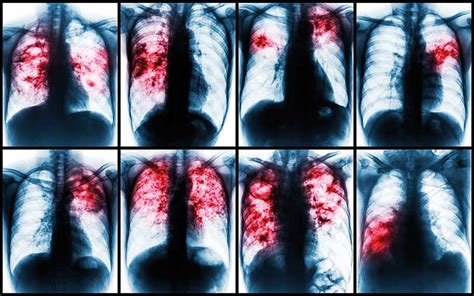 Penyakit Tuberkulosis Tbc Biologipedia Riset
