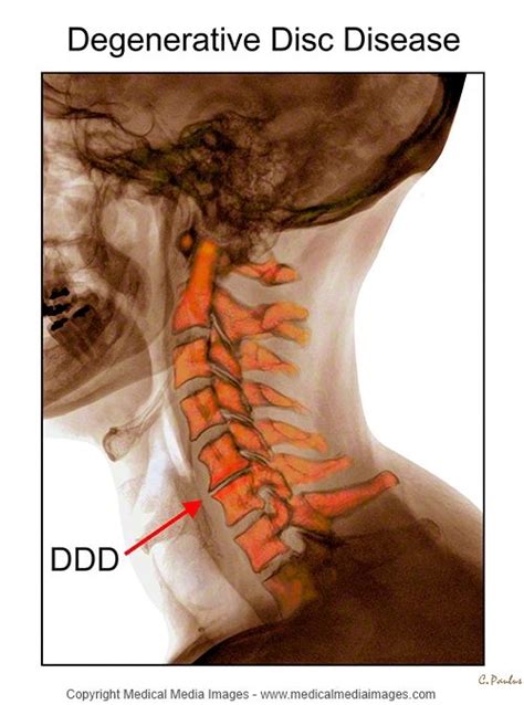 color x ray of the cervical spine showing degenerative disc disease ddd ideal for websites