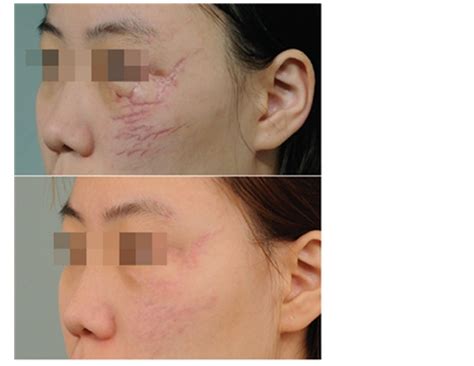 Fotos Do Tratamento De Cicatrizes Na Face Com Laser Fracionado Co2
