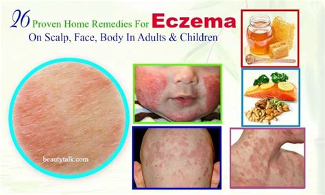26 Proven Home Remedies For Eczema On Scalp In Adults And Kids