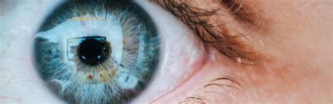 I felt like i was in good hands. In-Office Ocular Surgery - First Eye Care Downtown Dallas