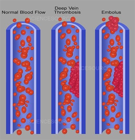 Photograph Blood Clots Science Source Images