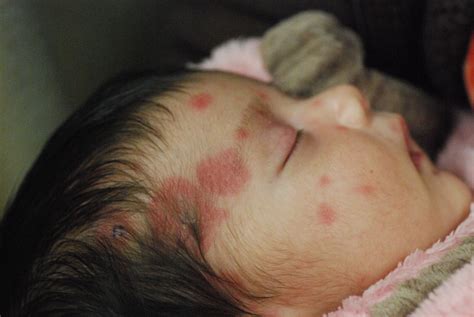 erythematous papules and plaques on a newborn a case of neonatal lupus erythematosus