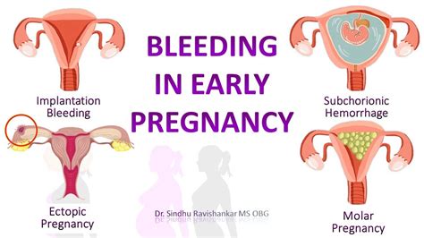 Bleeding In Early Pregnancy Implantation Bleeding What You Need To