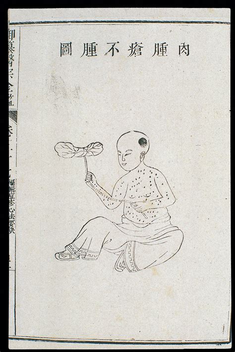 Chinese C18 Paed Pox Swollen Flesh Non Swollen Lesions