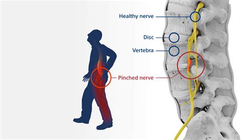 Vertiflex Procedure Lumbar Spinal Stenosis Treatment