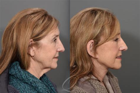 Facelift Before And After Photos Patient 1470 Serving Rochester