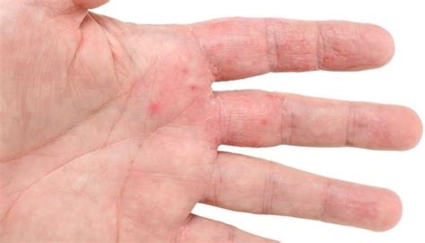 It can be related to atopic eczema. Types of Eczema and their Treatments - Part 1 ...