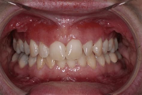 Gingival Swelling And Eythema With Sulcal Erythema Ulceration And