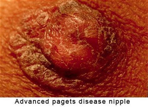 The condition is an uncommon disease accounting for 1 to 4.3% of all breast cancers and was first described by sir james paget in 1874. Magic Moment Of Life: Paget's disease-new kind of Breast ...