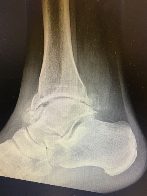 Osteoarthritis Of The Foot And Ankle