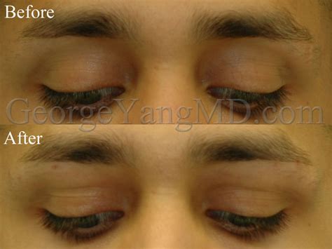 Upper Eyelid Filler George Yang Md New York Facial Plastic Surgeon