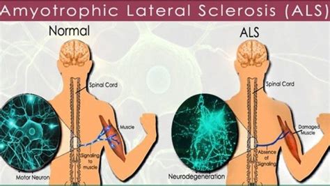 Comprehensive Overview of ALS: Symptoms, Causes, Diagnosis, Treatment, and Research