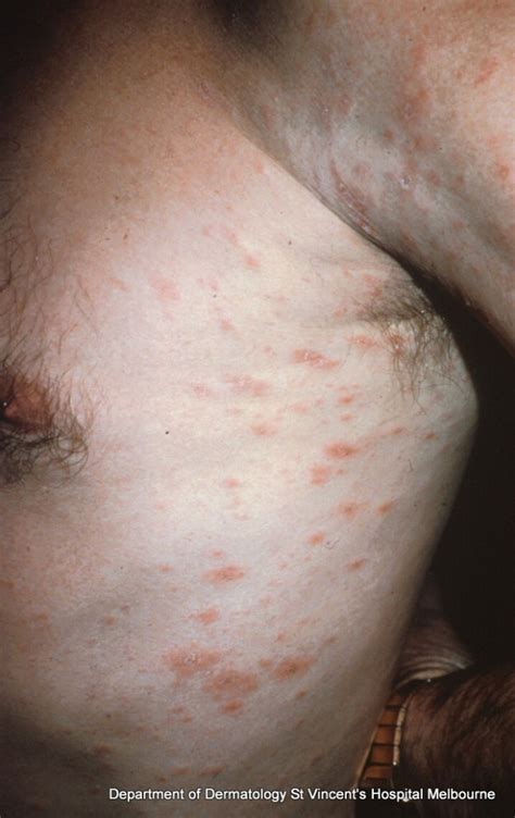 Pityriasis Rosea A Z Of Skin