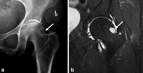 Mri Of The Hip For The Evaluation Of Femoroacetabular Impingement Past