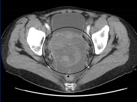 Solid Tumour With Cystic Areas And Haemorrhagic Fluid Mcq