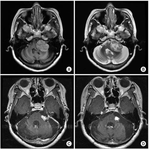 Vestibular Schwannoma On Brain Mri A T1 Weighted Image Of Vestibular