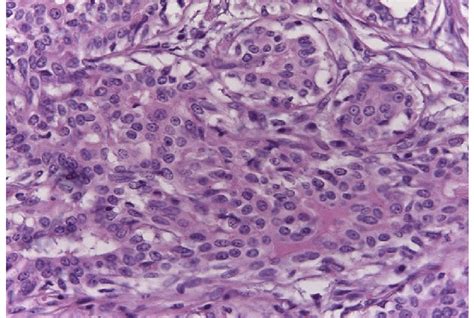 Sheets Of Pleomorphic Epithelial Cells With A Marked Variation In Cell