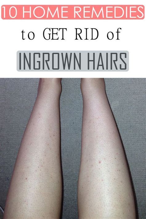 Ingrown Hairs Commonly Known As Razor Bumps Are Curled Hair That