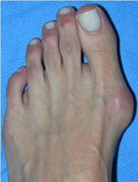 Bunion Surgery Before And After Pictures Best Podiatrist Nyc