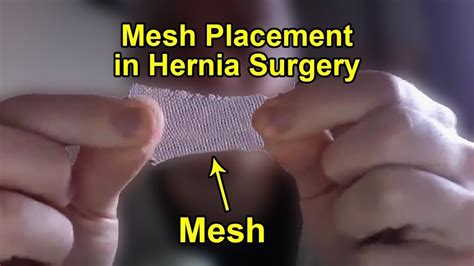 How Surgeons Repair Hernia With Mesh Laparoscopic Inguinal Hernia